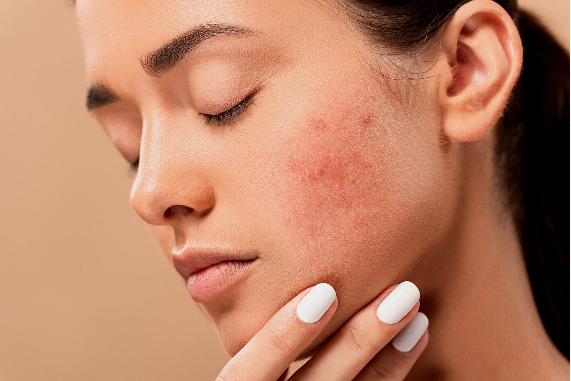 Causes of adult acne