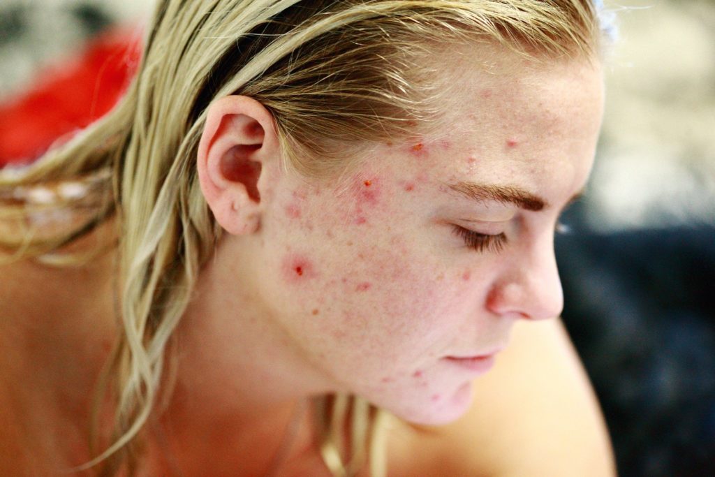 Biotin acne breakout 